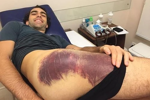 Benite exibe hematoma na perna / Foto: Arquivo Pessoal